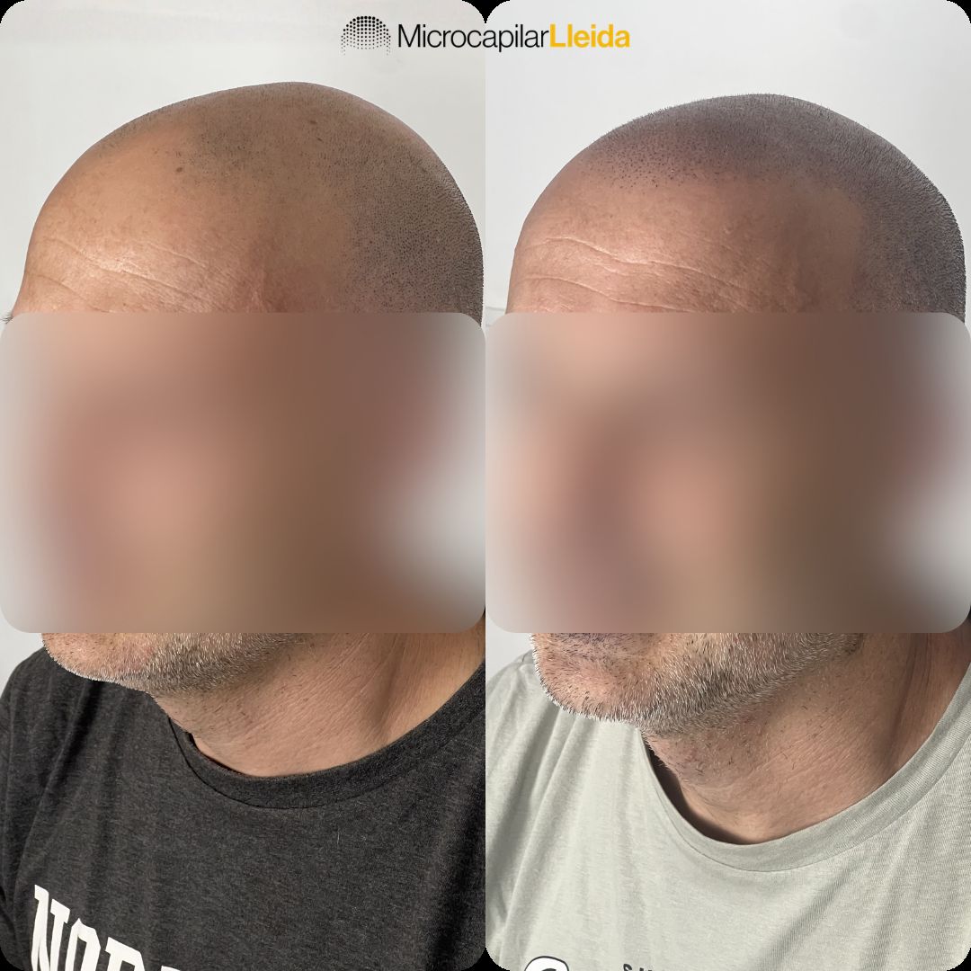 Caso de micropigmentación capilar antes y después en Lleida — caso 4