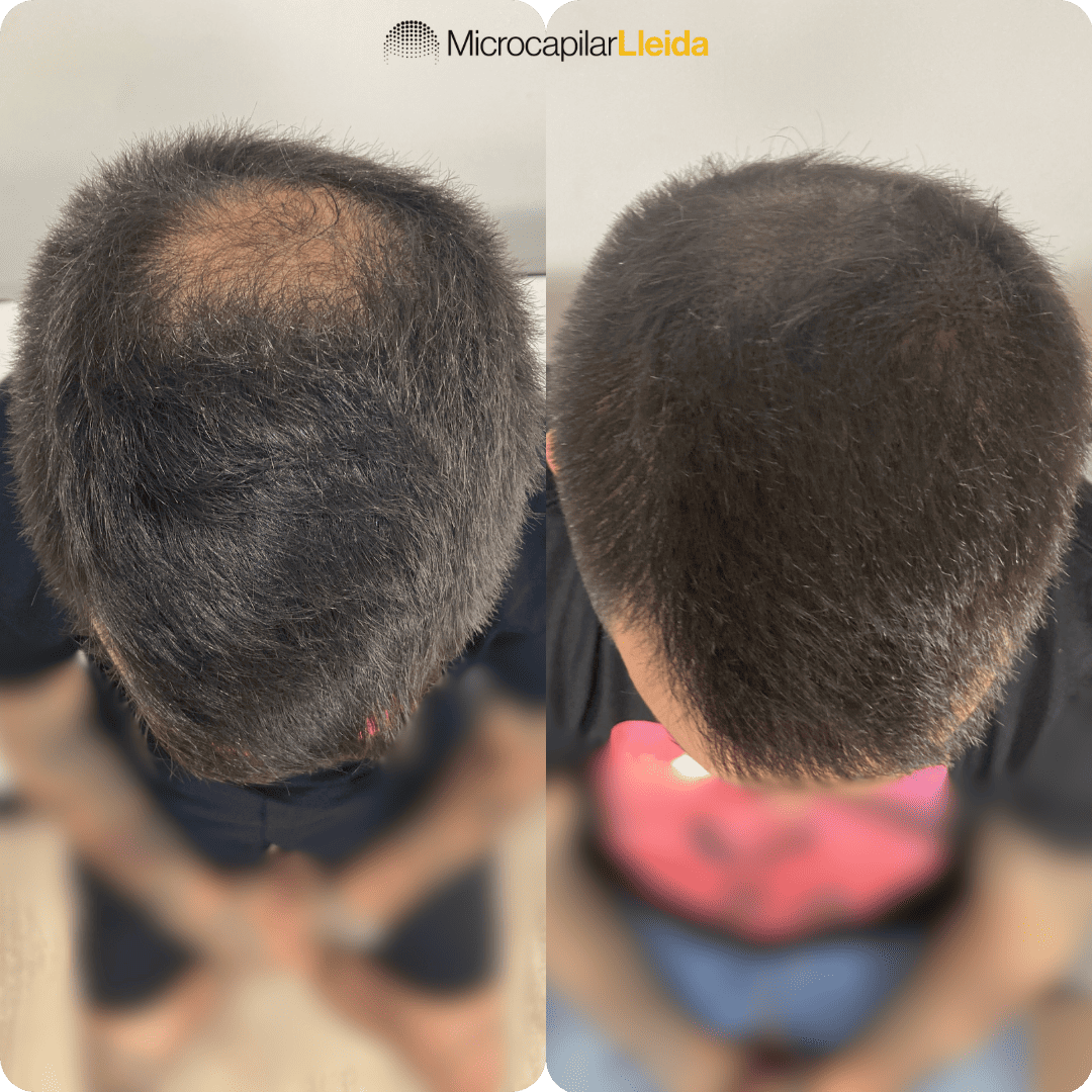 Resultado micropigmentación capilar — caso 4