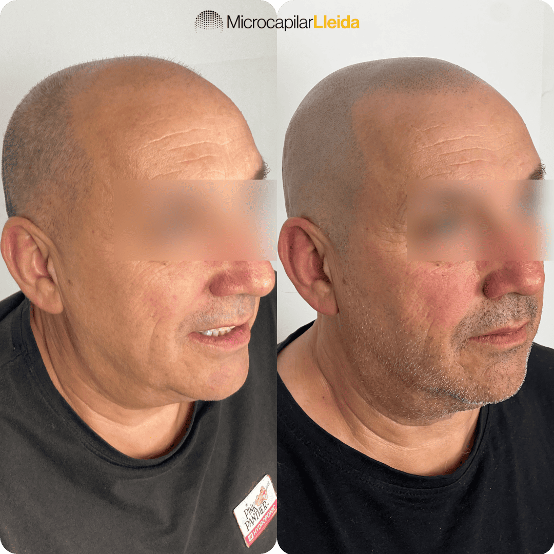 Resultado micropigmentación capilar — caso 3