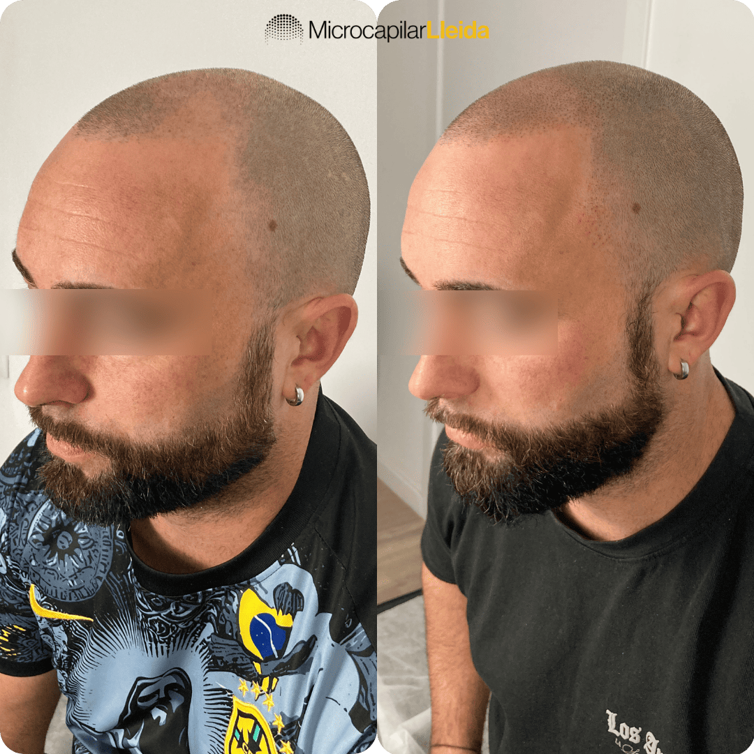 Resultado micropigmentación capilar — caso 2