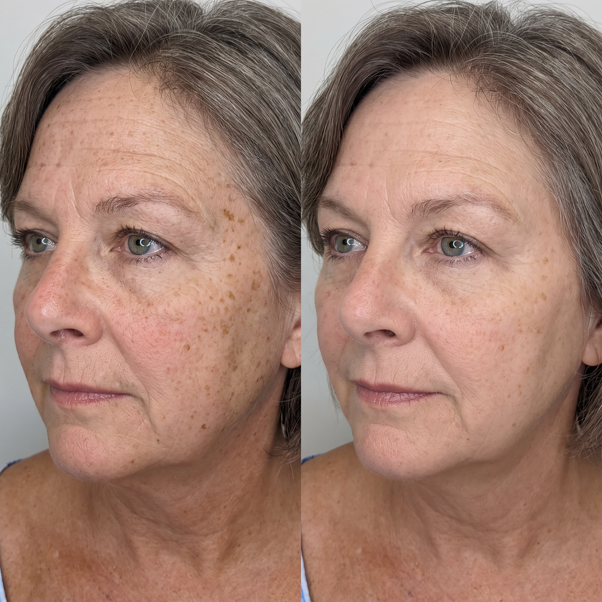 Skin treatment before and after