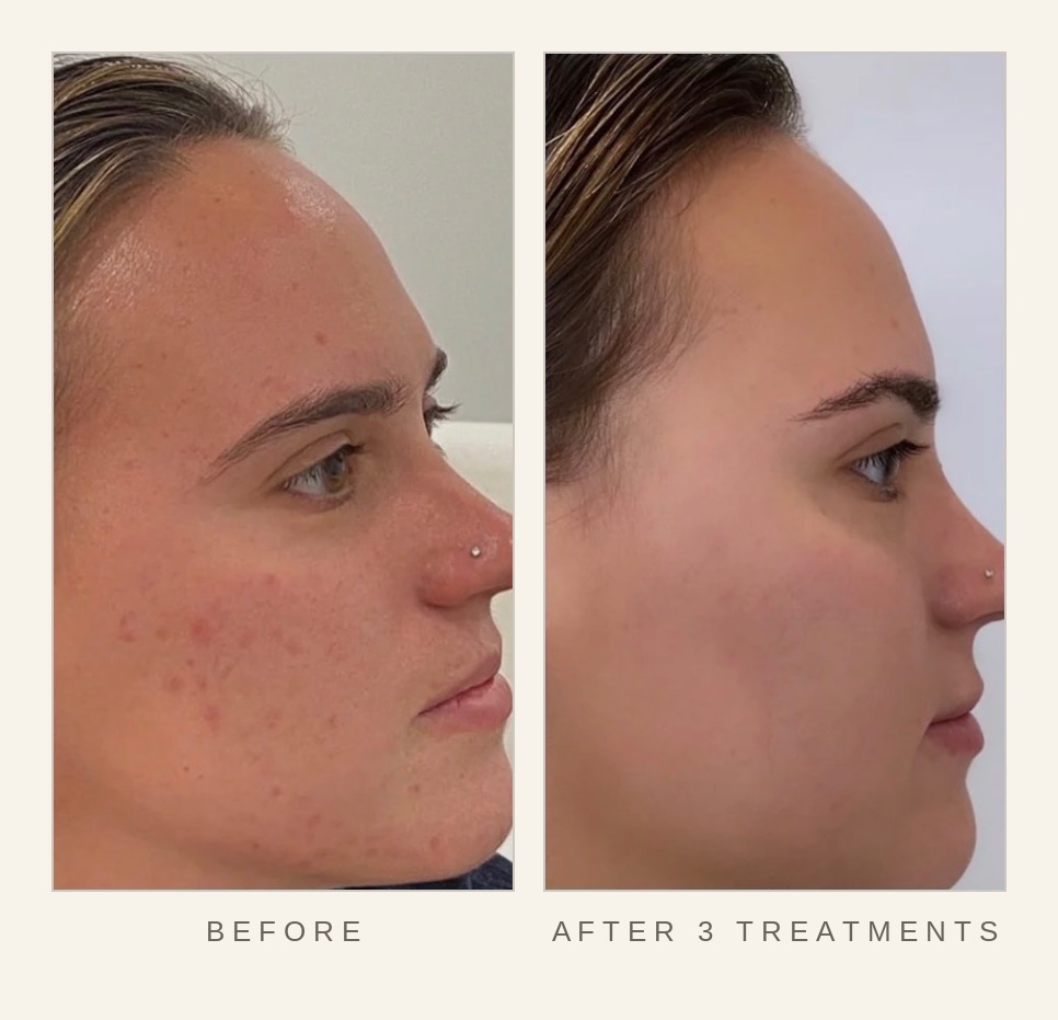 Microneedling before and after three treatments