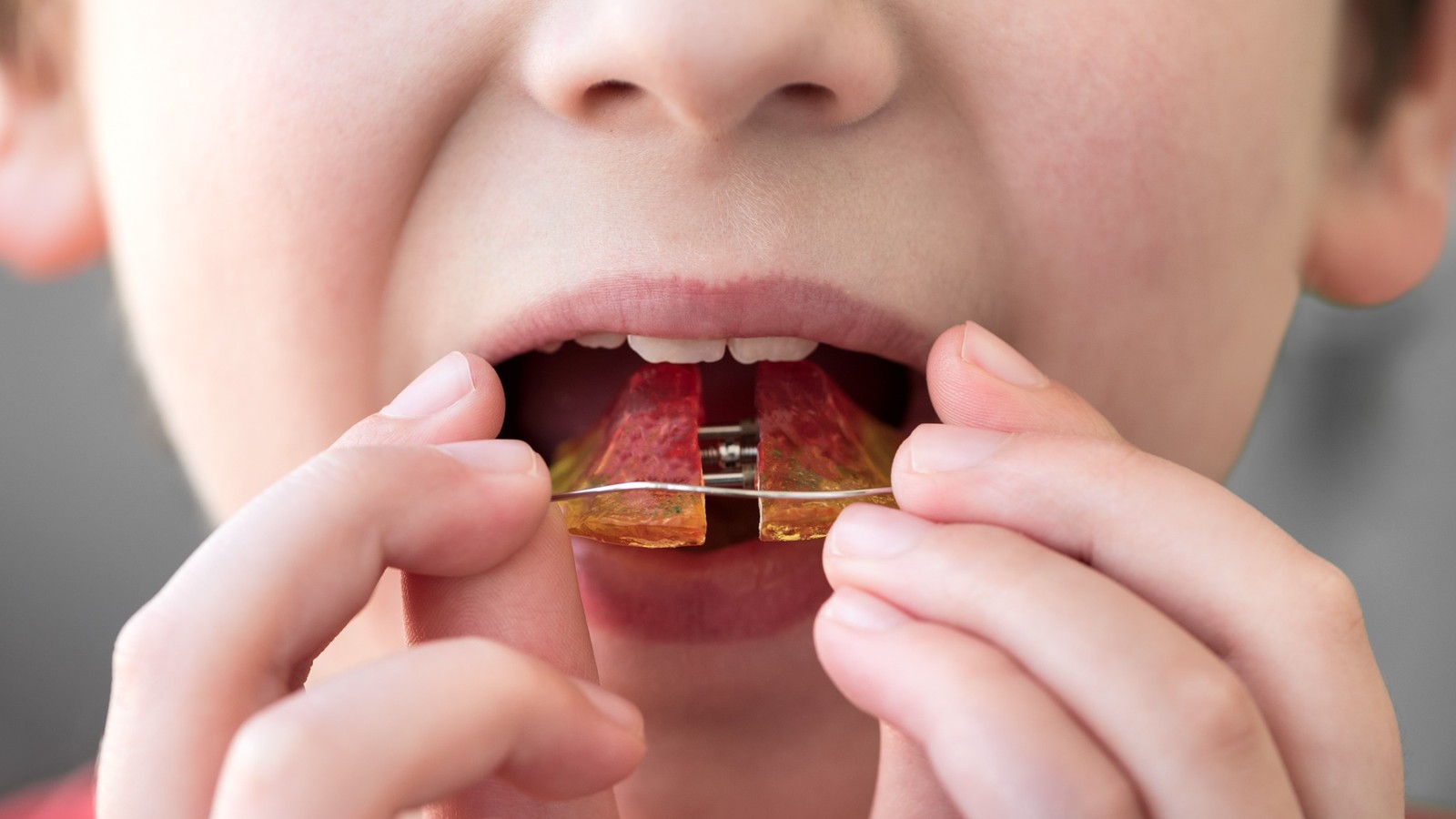 Myofunctional therapy and orthodontics