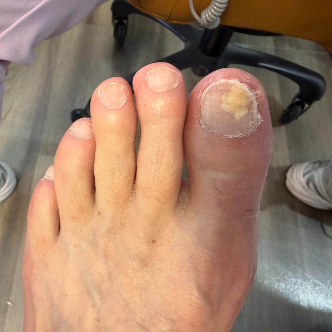 Before laser nail fungus treatment at Podiatry Boutique