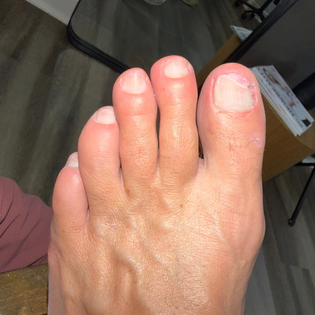 After laser nail fungus treatment at Podiatry Boutique