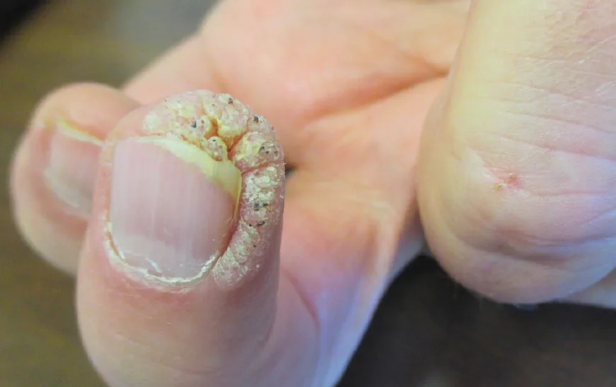 Thickened, discolored toenail affected by a stubborn nail infection