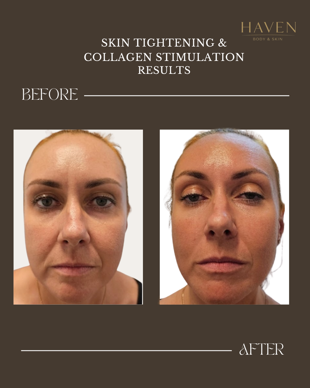 Skin Tightening - Face