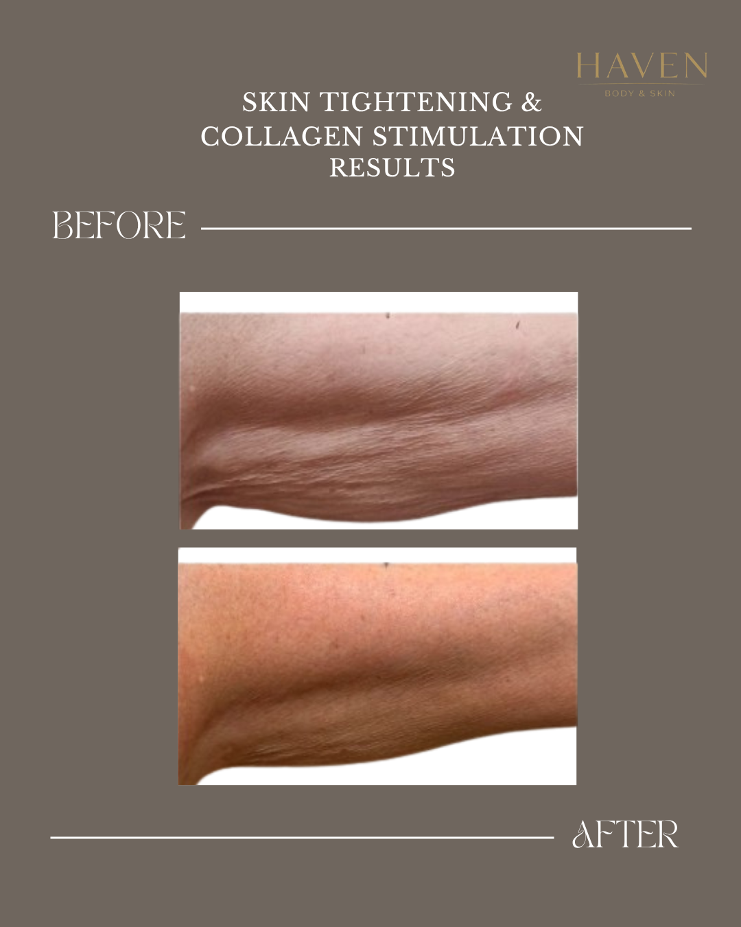 Skin Tightening - Arms