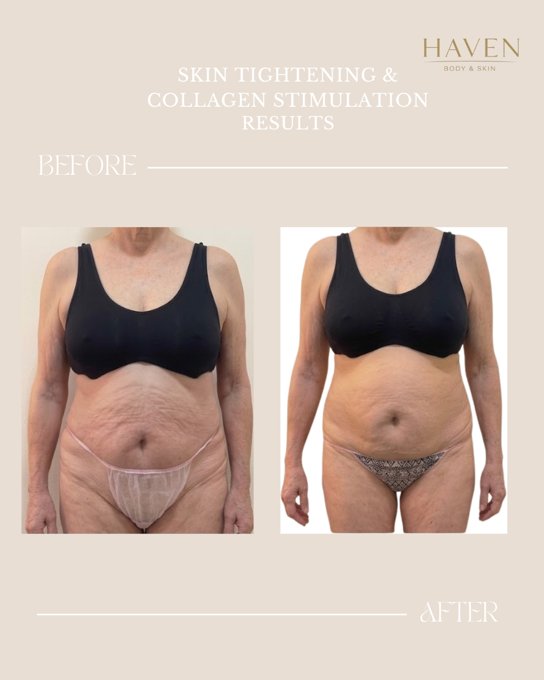 Skin Tightening - Stomach & Thighs