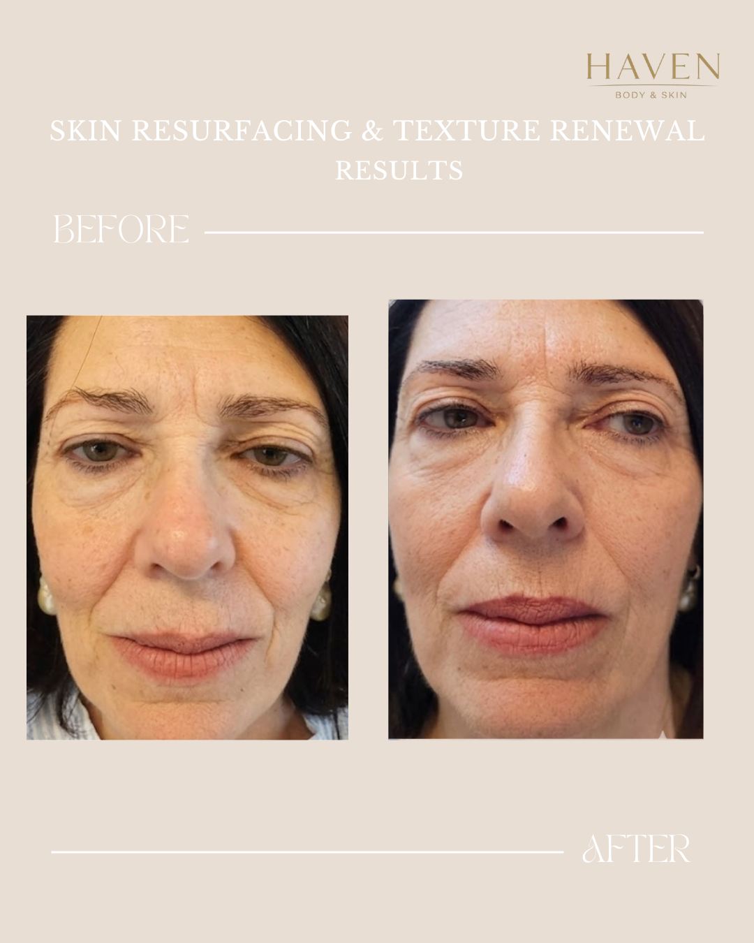 Skin Tightening - Face