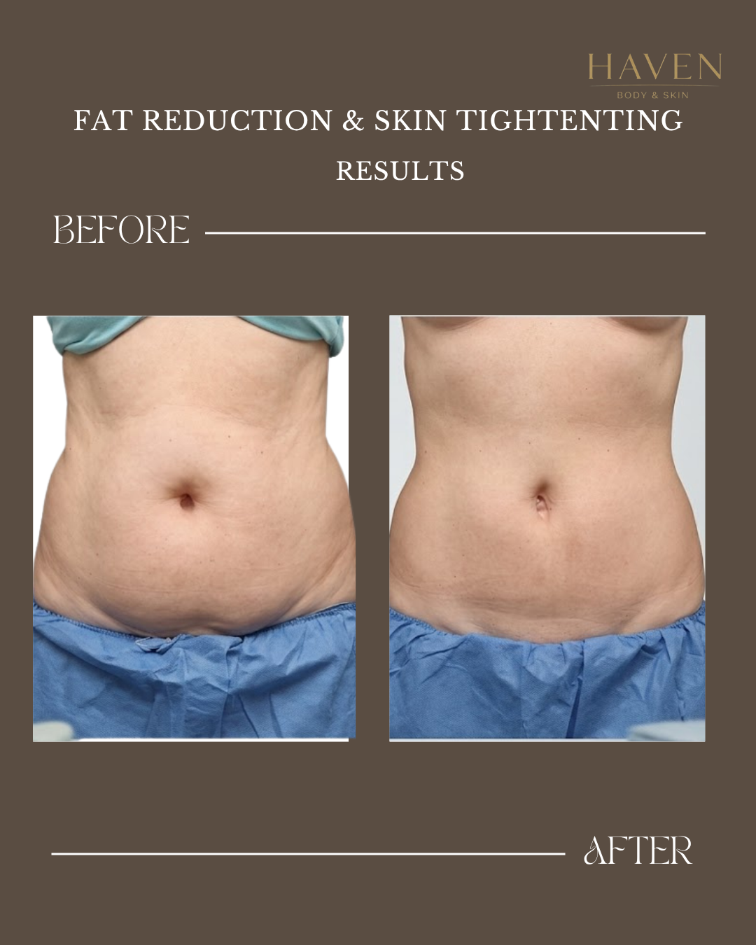 Skin Tightening - Stomach