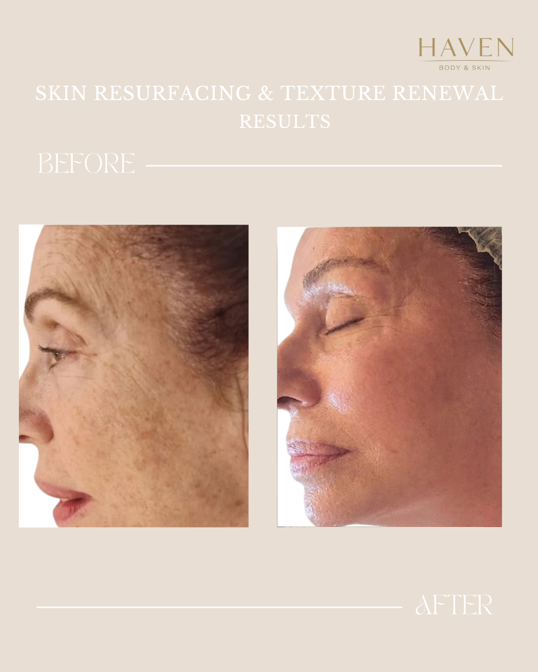 Skin Rejuvenation - Face & Neck