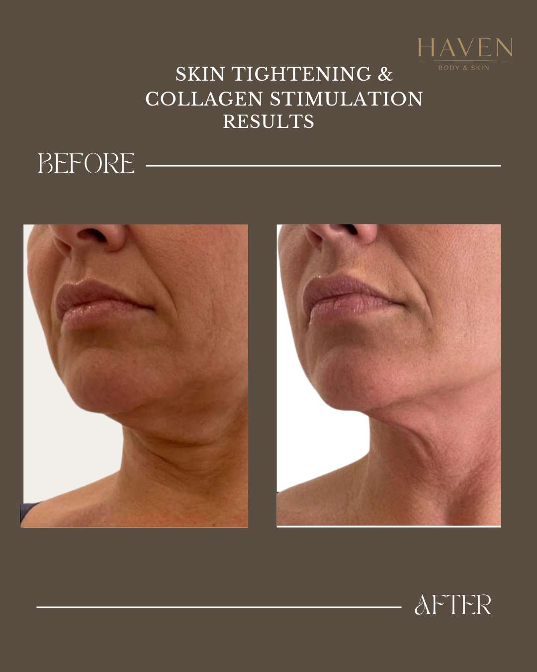 Skin Tightening - Neck