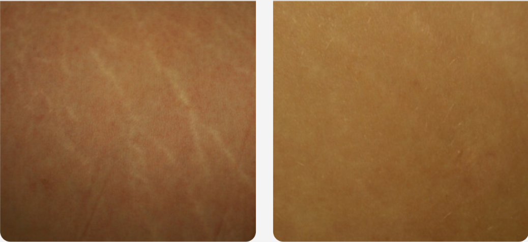 Stretch Marks
