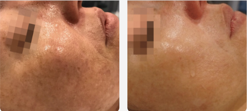 Pigmentation