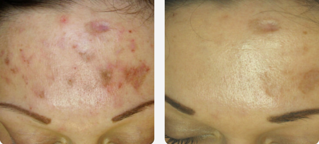 Acne Scarring