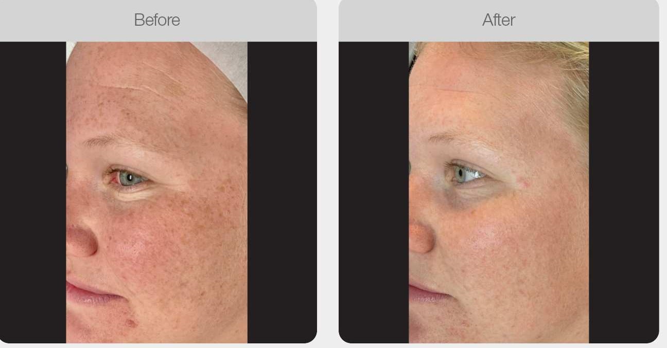 IPL Pigmentation Correction result