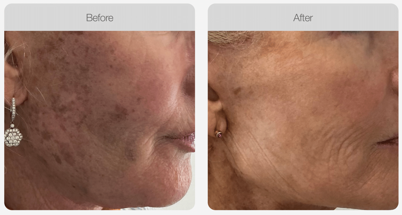 IPL Pigmentation Correction result