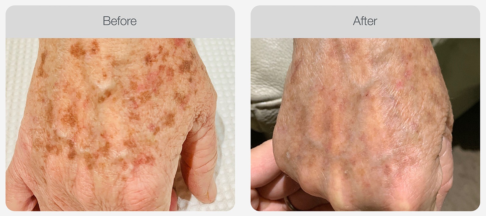 IPL Pigmentation Correction result