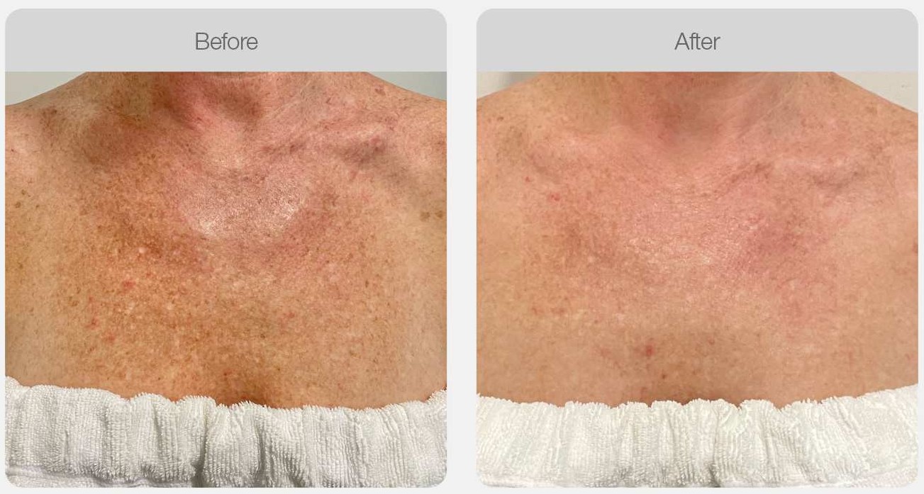 IPL Pigmentation Correction result