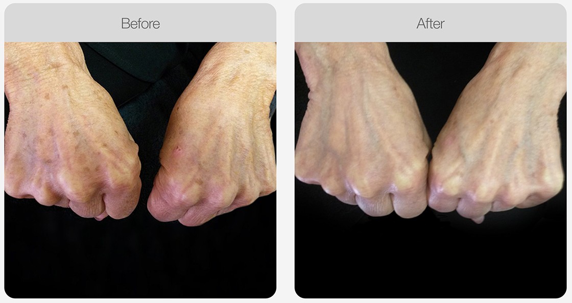IPL Pigmentation Correction result