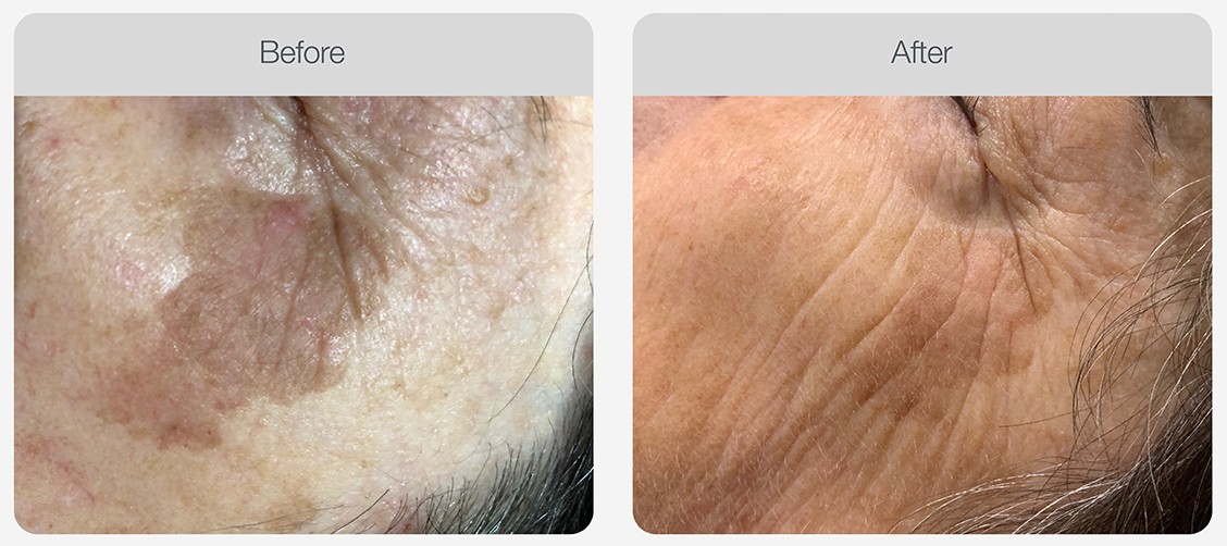 IPL Pigmentation Correction result