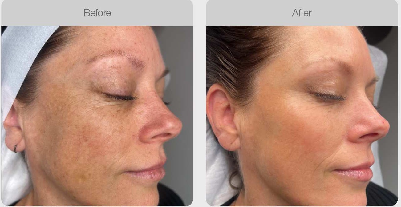 IPL Pigmentation Correction result