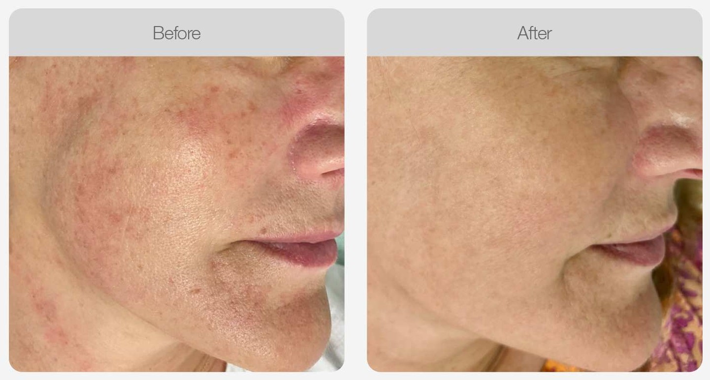 IPL Pigmentation Correction result