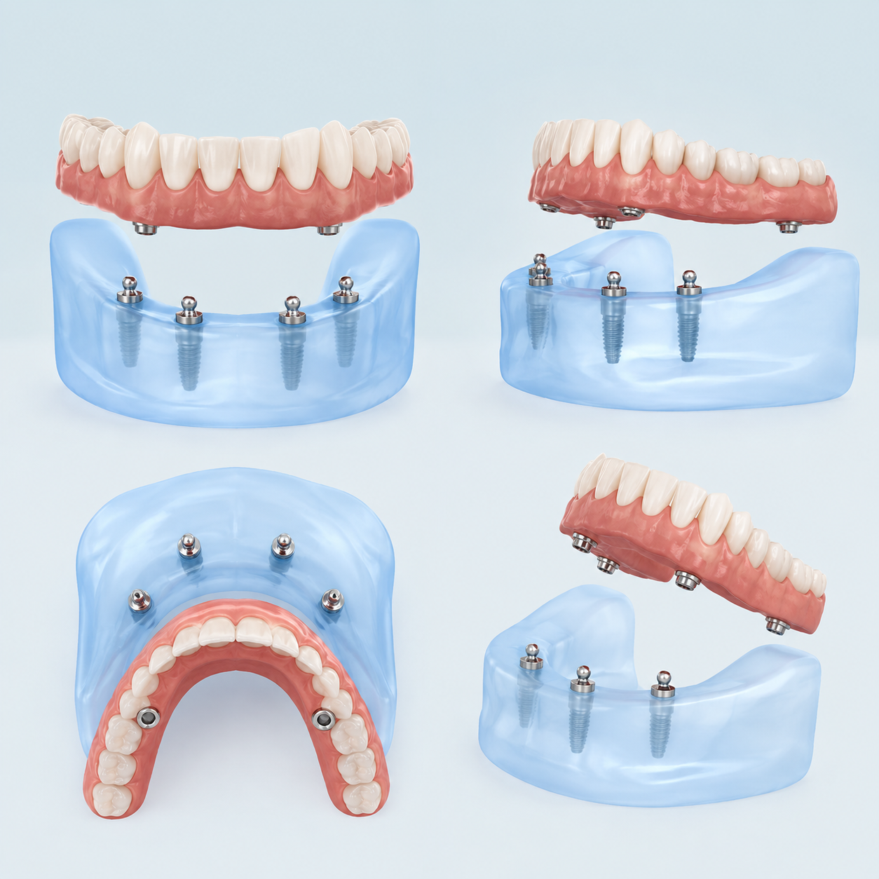 A snap-in denture secured on two implants