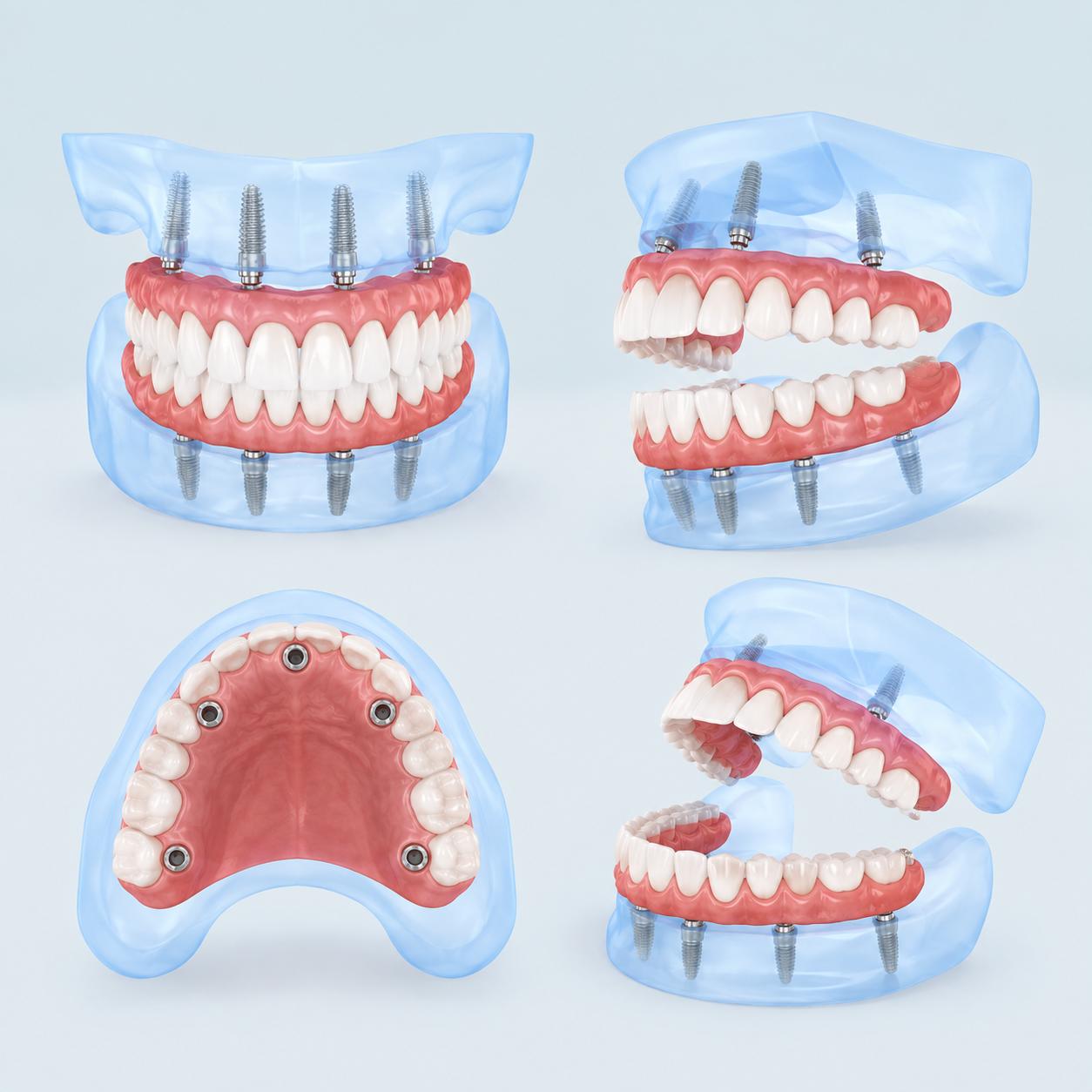 A fixed full-arch bridge on four implants