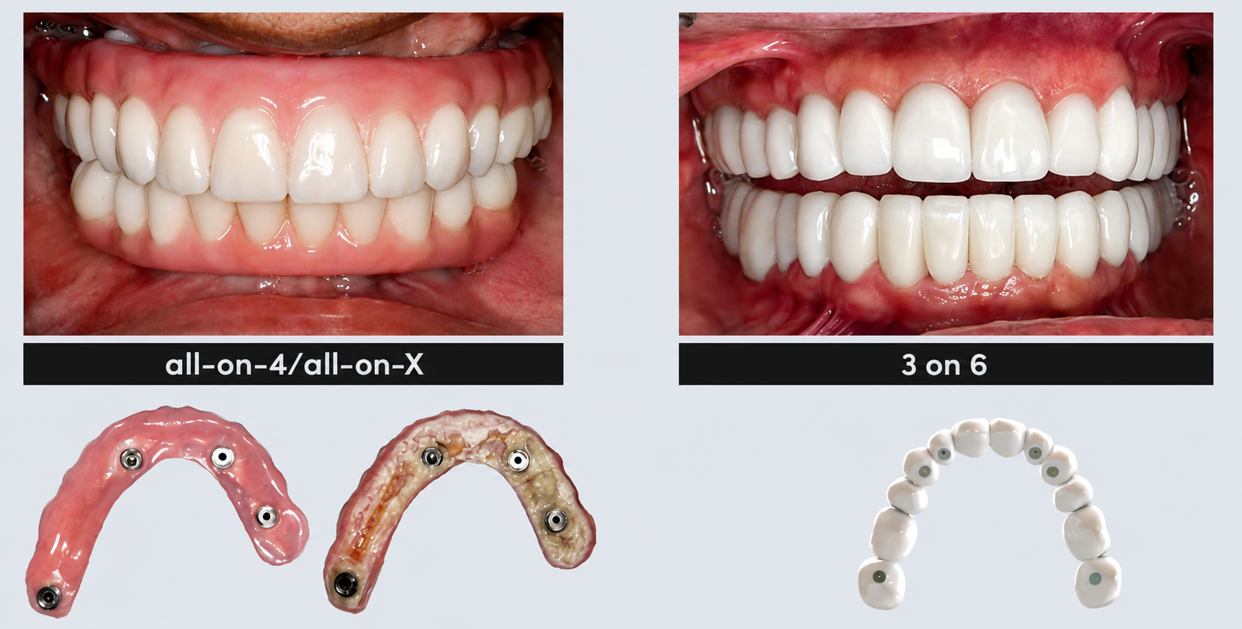 Side-by-side comparison of a 3 On 6 restoration and a conventional All-on-4 restoration