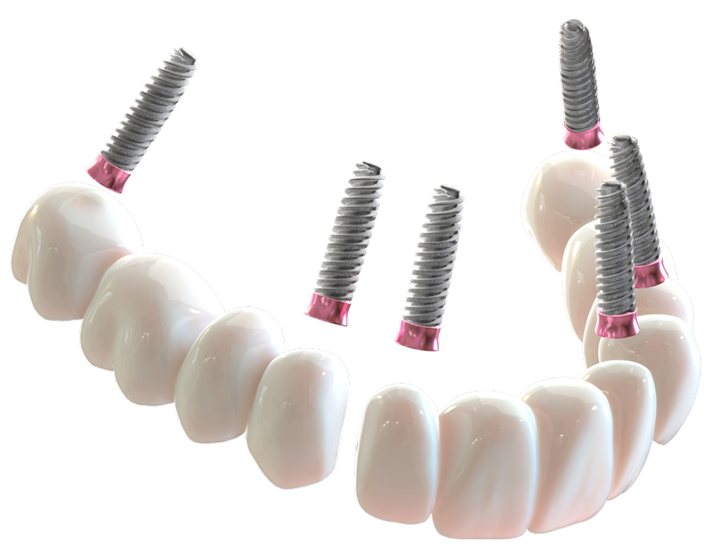 3D rendering of a 3 On 6 upper arch