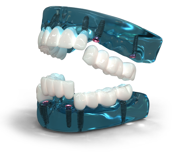 3D rendering of a 3 On 6 full-arch restoration