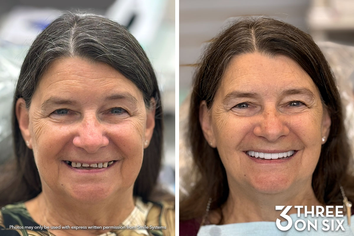 Before and after photos of a 3 On 6 full-arch patient