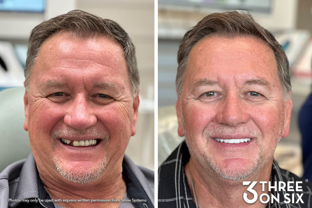 Before and after photos of a 3 On 6 full-arch patient