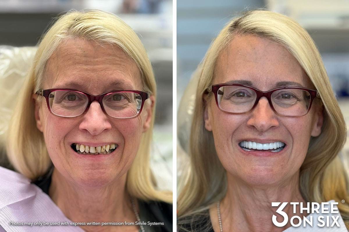 Before and after photos of a 3 On 6 full-arch patient