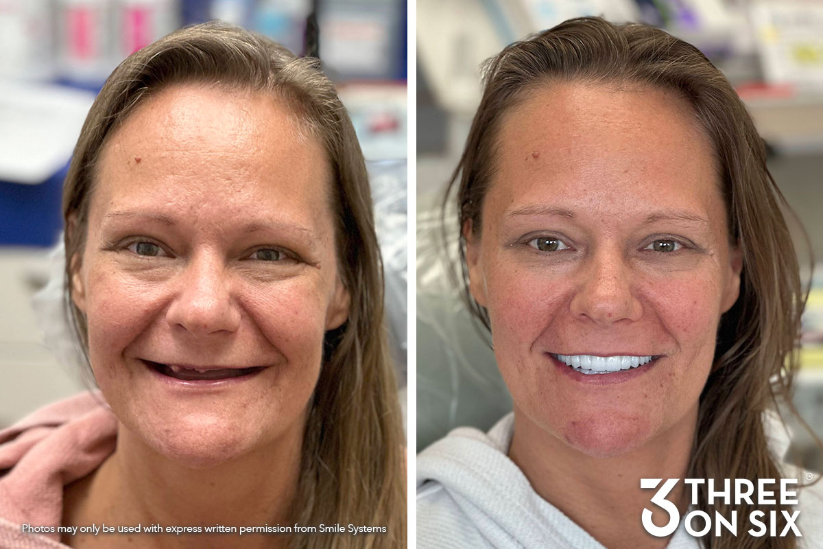 Before and after photos of a 3 On 6 full-arch patient