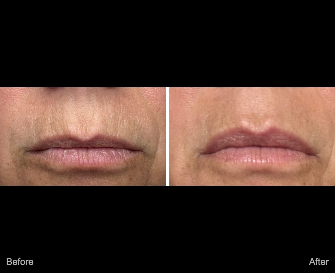 Neora skincare before and after results