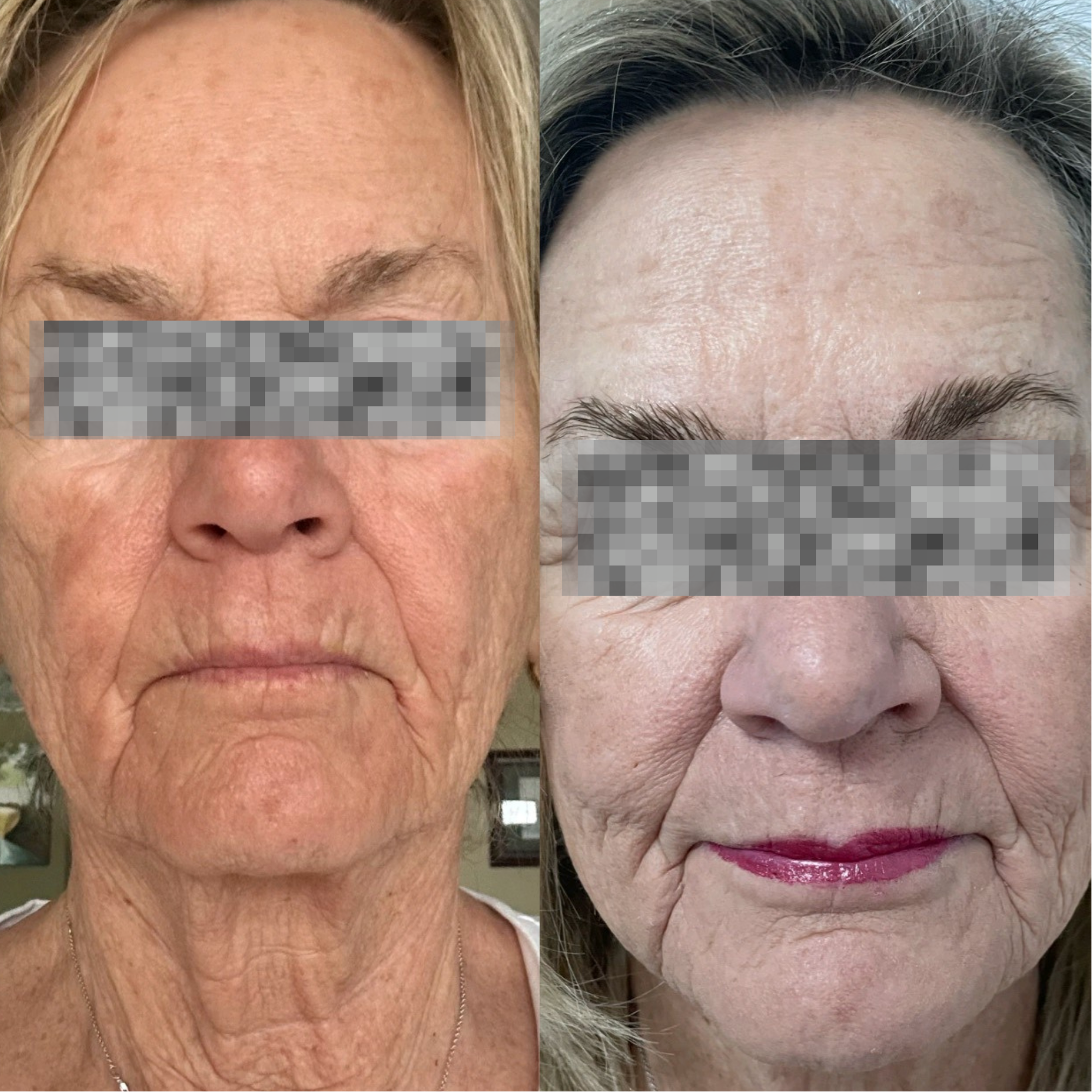 Before and after result 3
