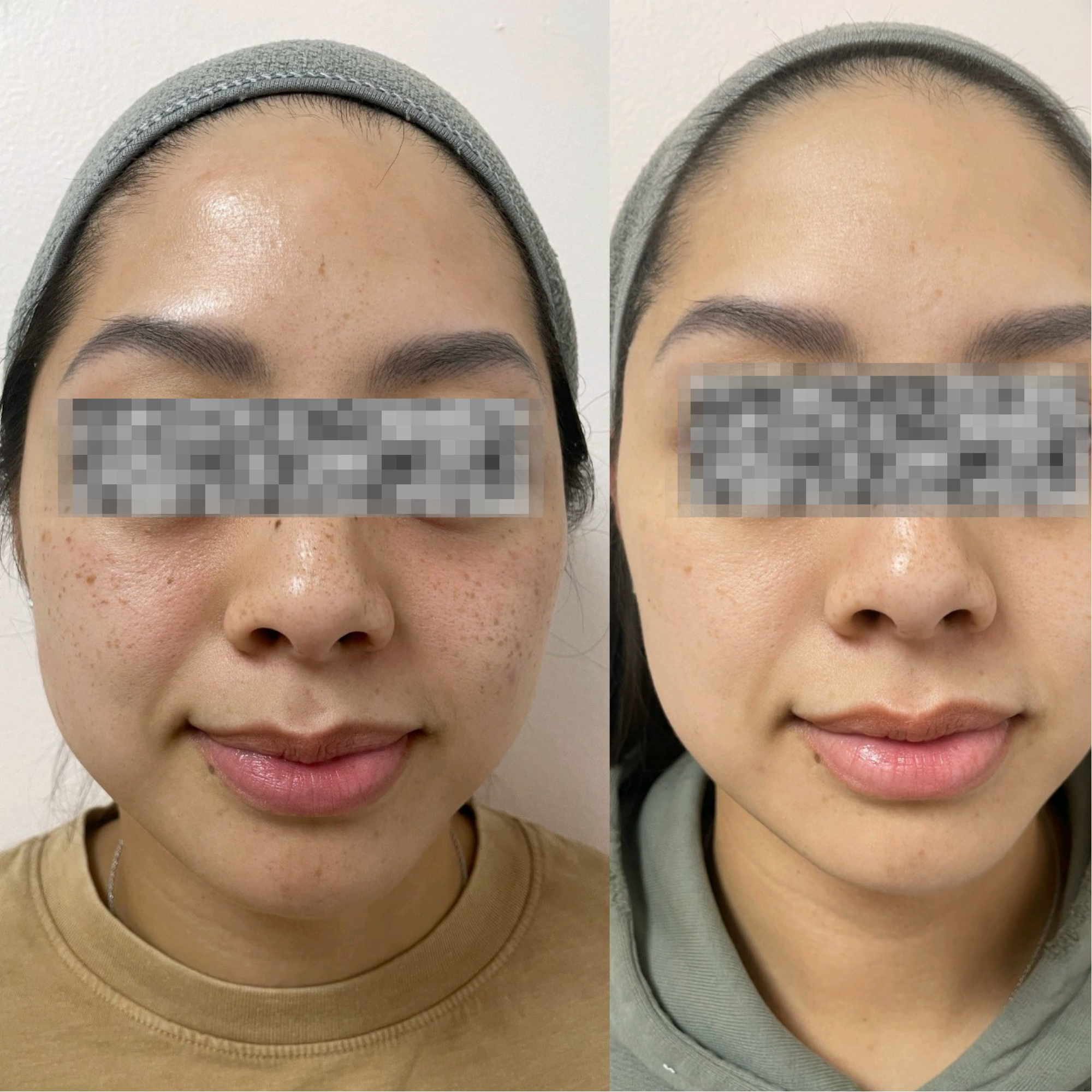 Before and after result 1