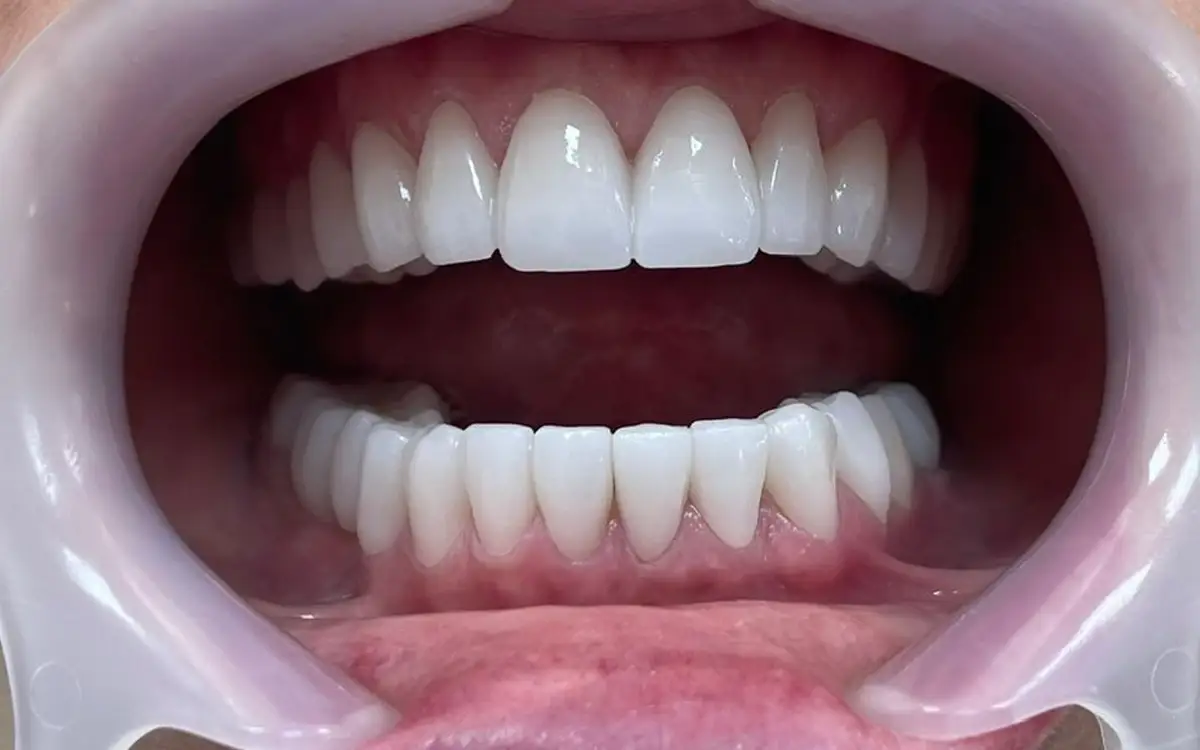 Before dental treatment 2