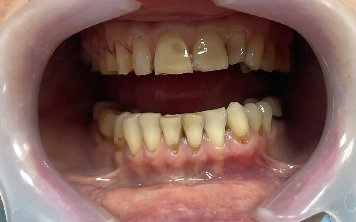 After dental treatment 2