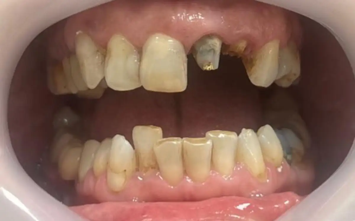 After dental treatment 3