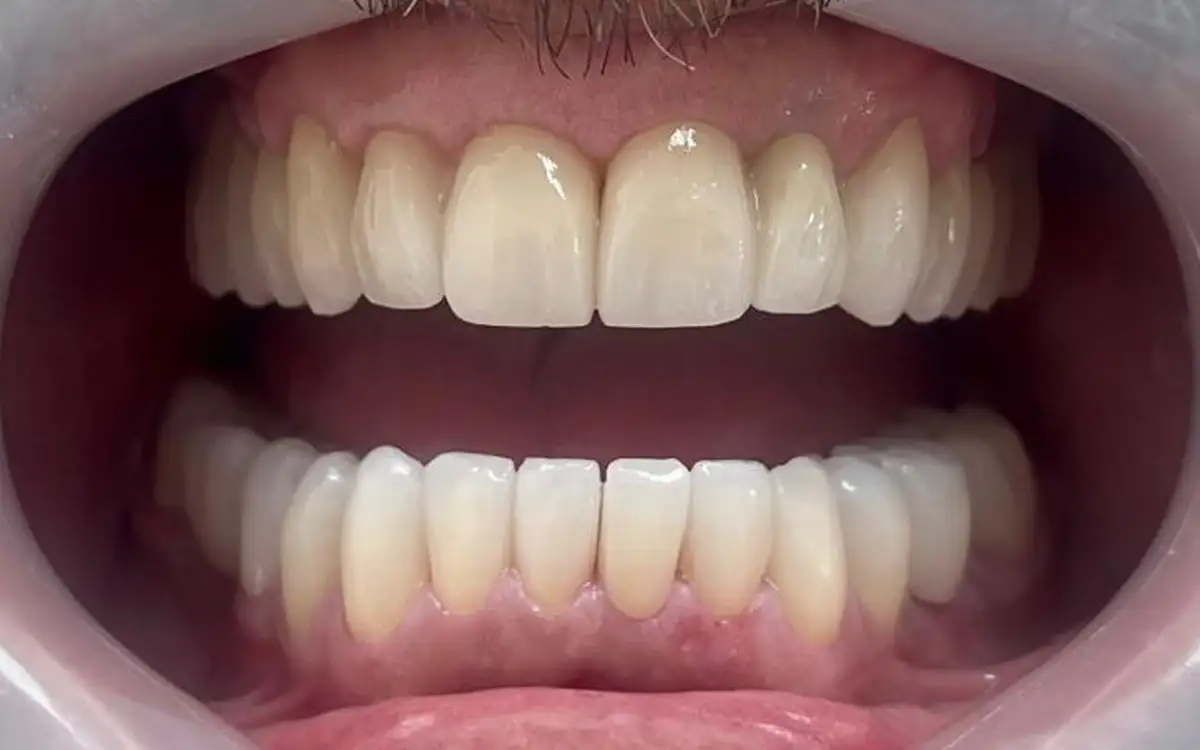 Before dental treatment 1