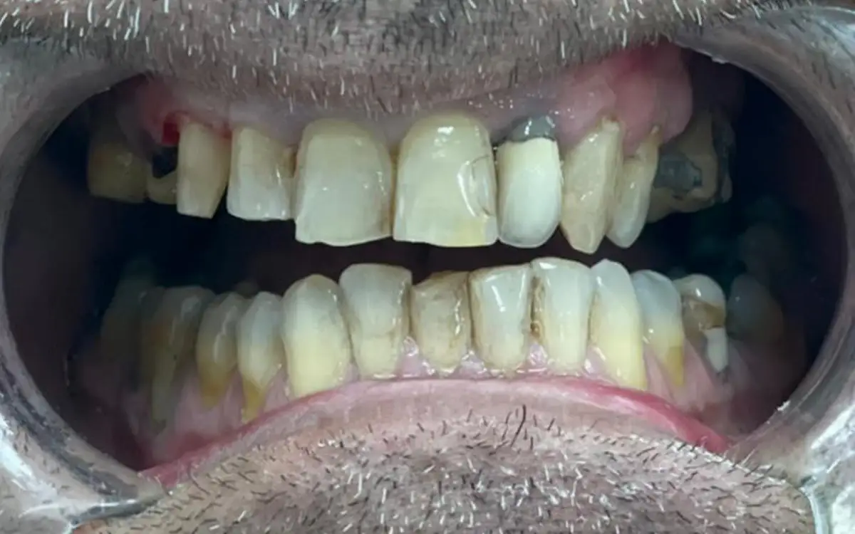 After dental treatment 1