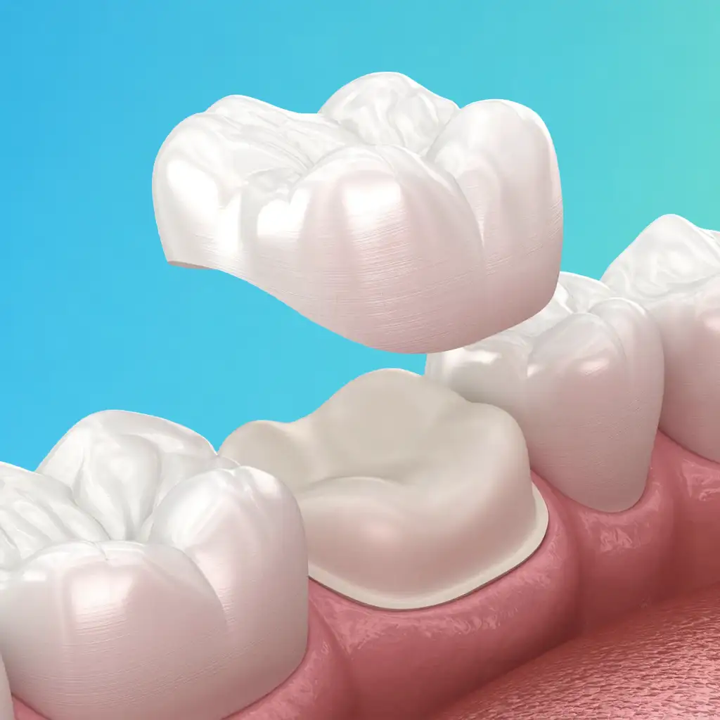 Dental Crowns