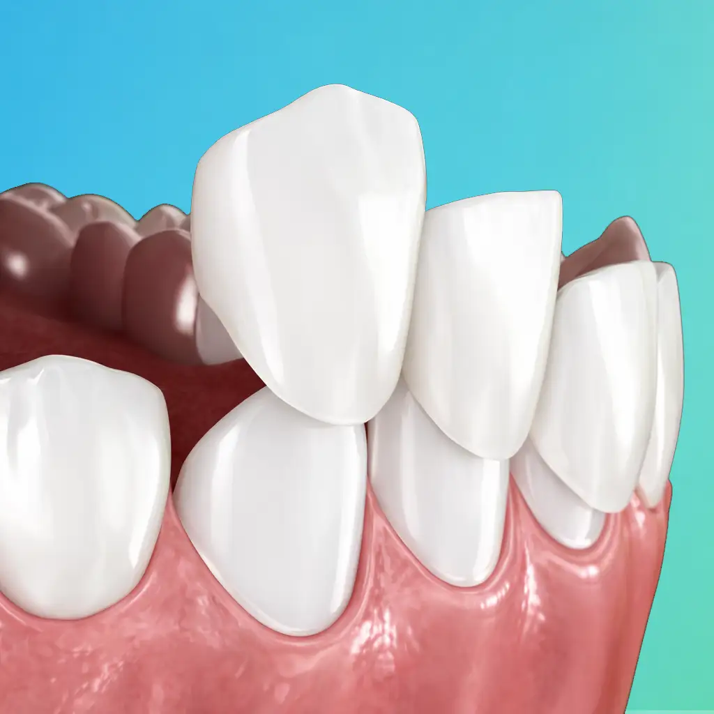 Dental Veneers