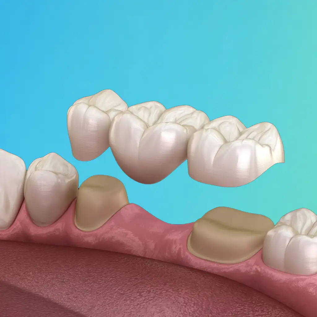 Dental Bridges