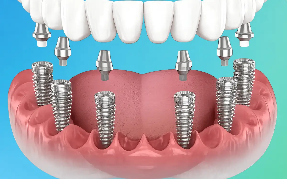 All-on-6 Dental Implants