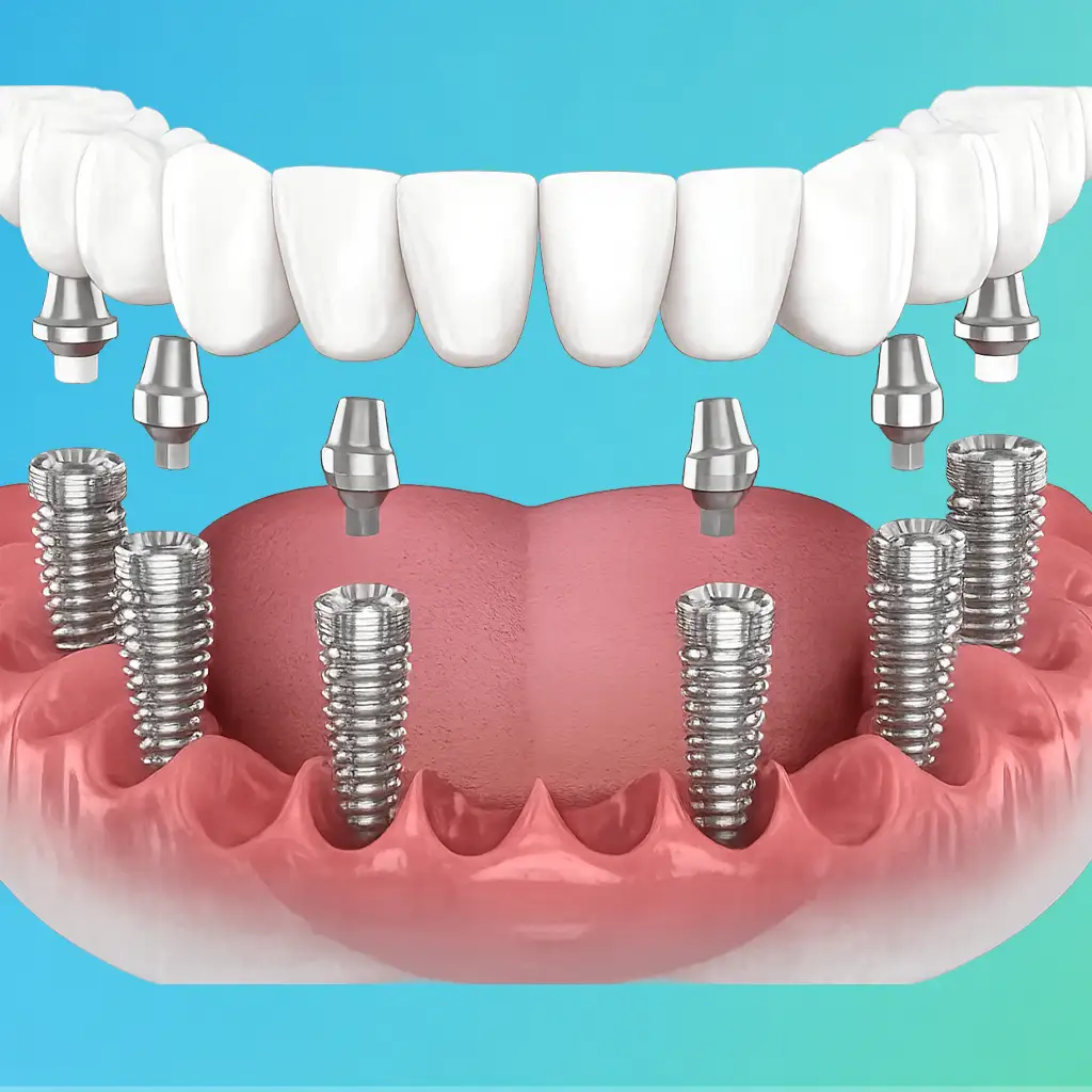 Dental Implant Consultation